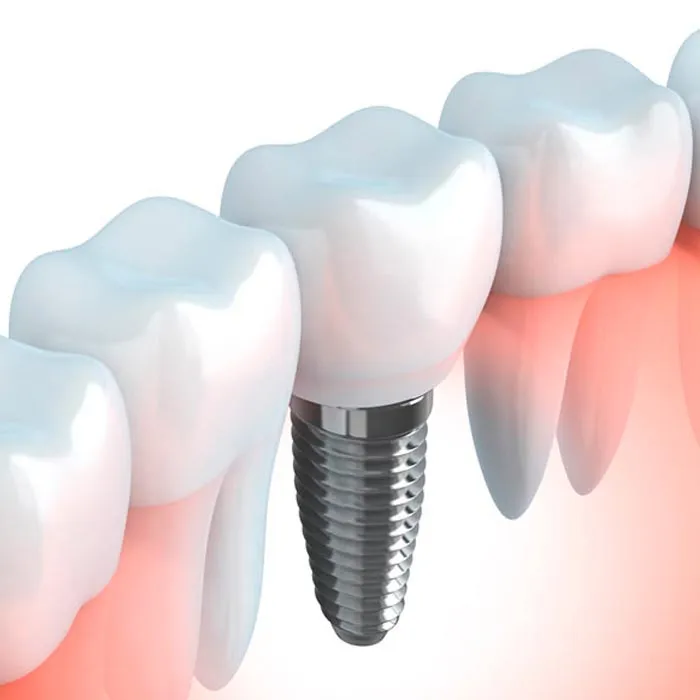 Implantes dentales